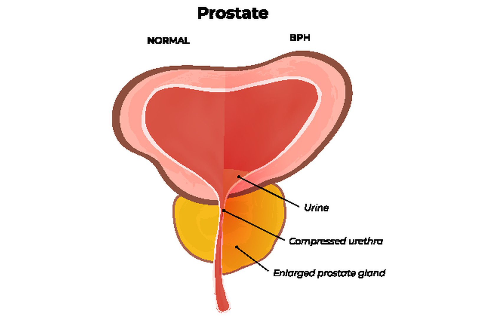 Finasteride